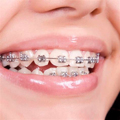 ventajas y desventajas de los brackets metalicos|ortodoncia de brackets metalicos.